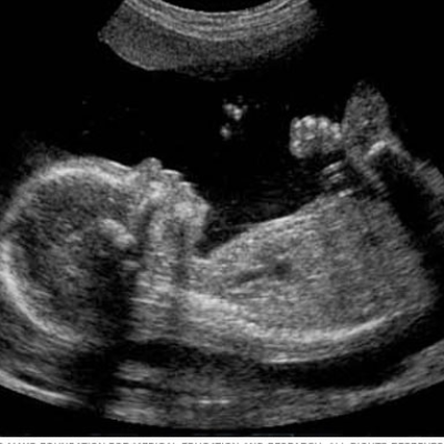 Fetal Ultrasound Course